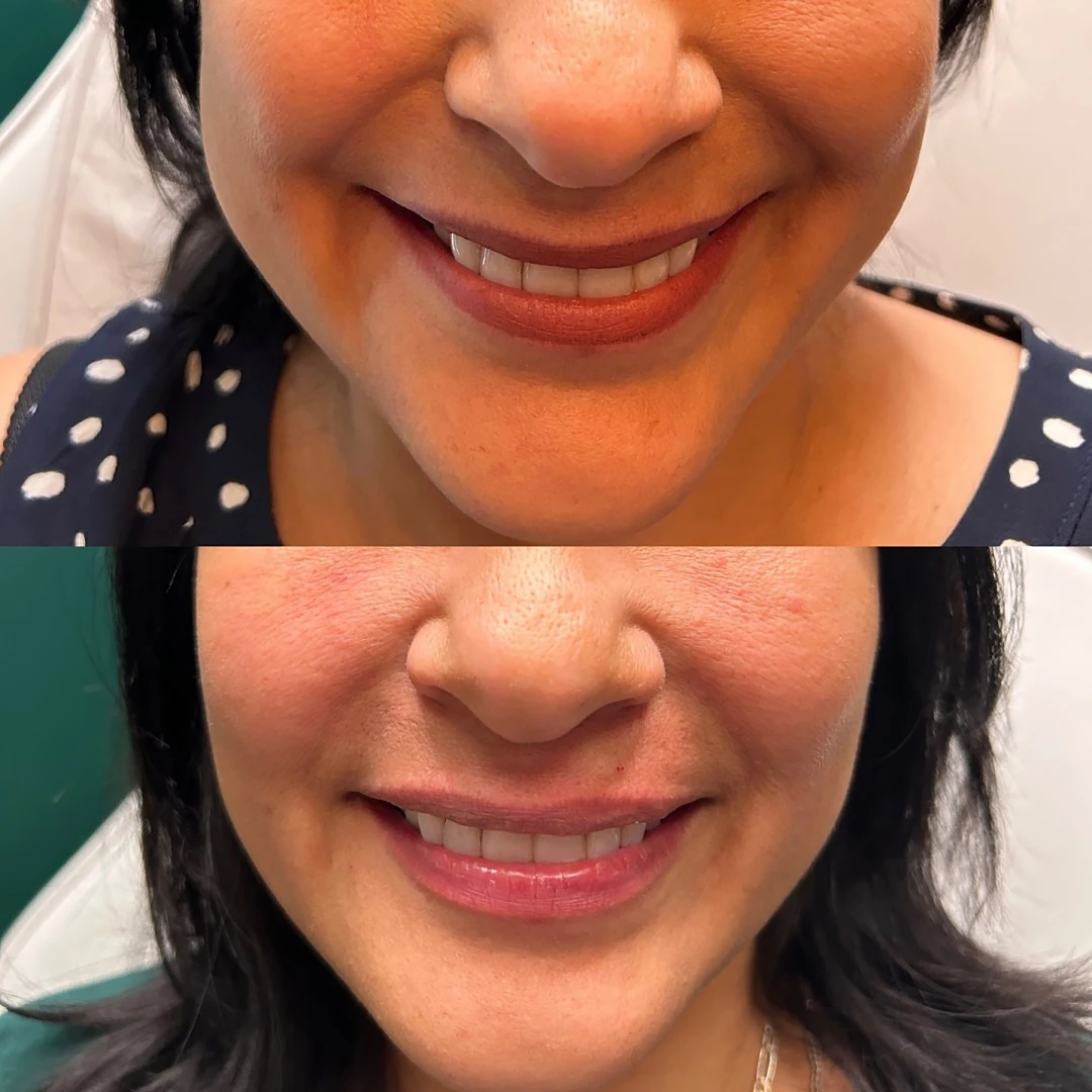 Before-After-Aesthetic-Med-Spa-Fresno-by-Skin-Sculpt-Aesthetics1
