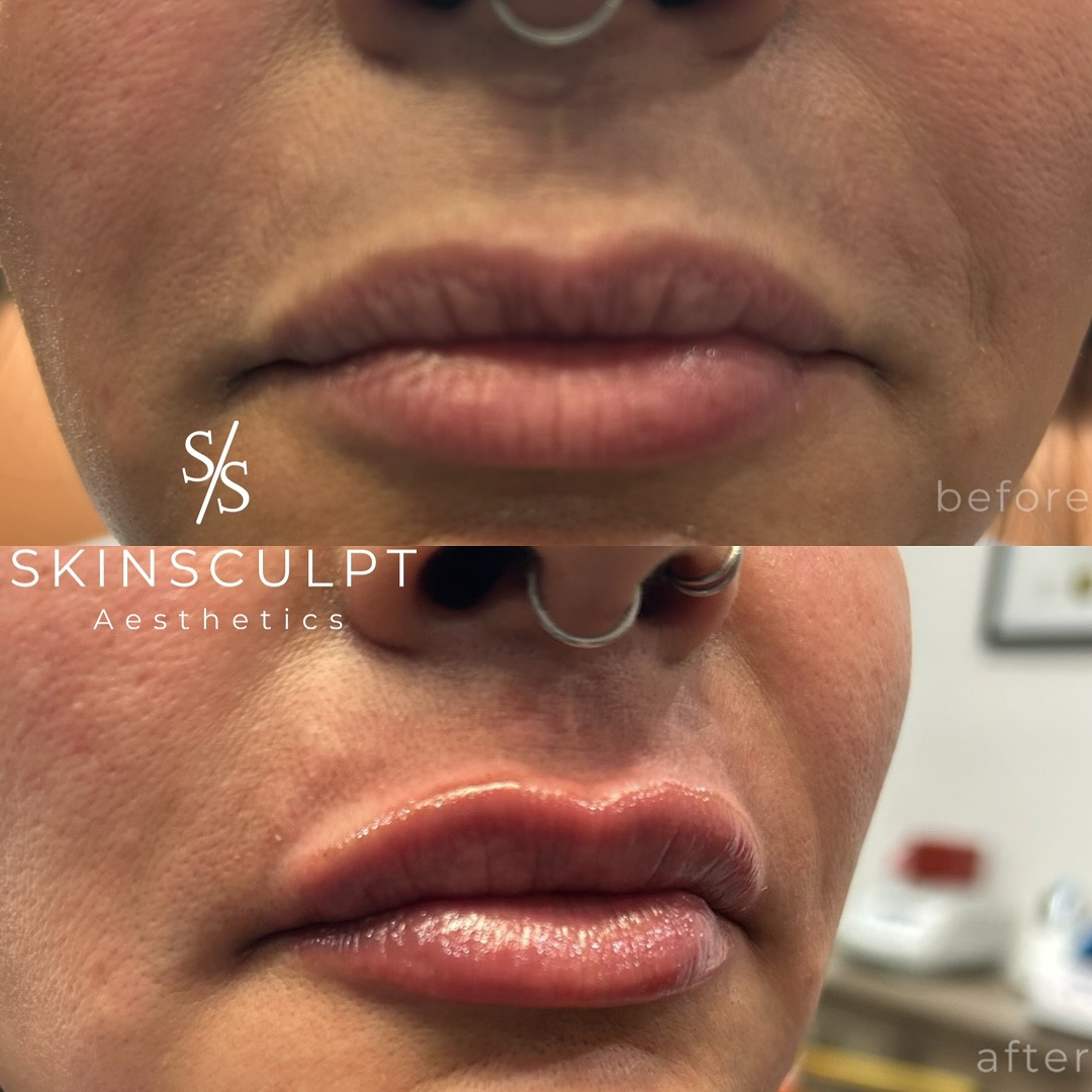 Before-After-Aesthetic-Med-Spa-Fresno-by-Skin-Sculpt-Aesthetics12