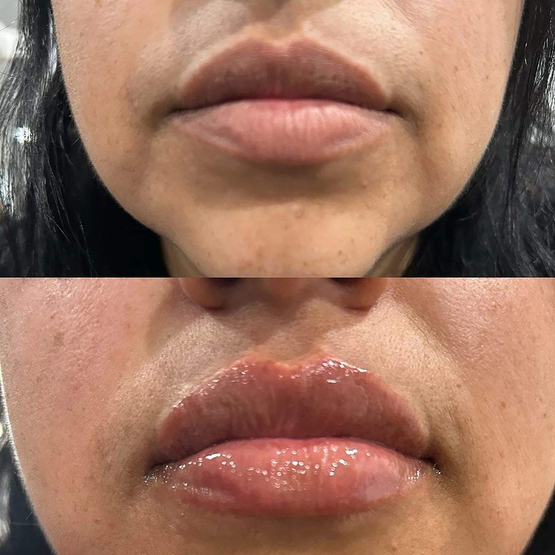 Before-After-Aesthetic-Med-Spa-Fresno-by-Skin-Sculpt-Aesthetics13