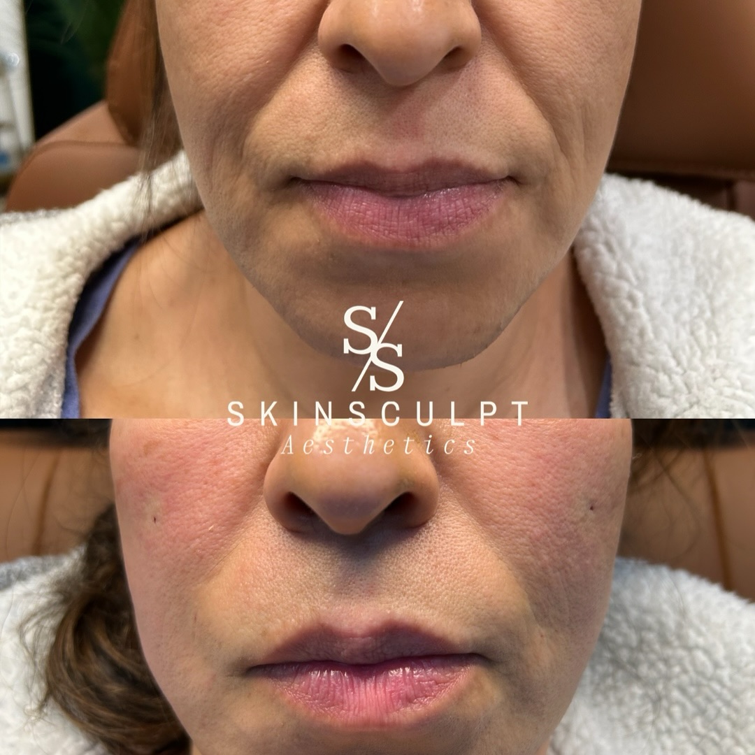 Before-After-Aesthetic-Med-Spa-Fresno-by-Skin-Sculpt-Aesthetics15