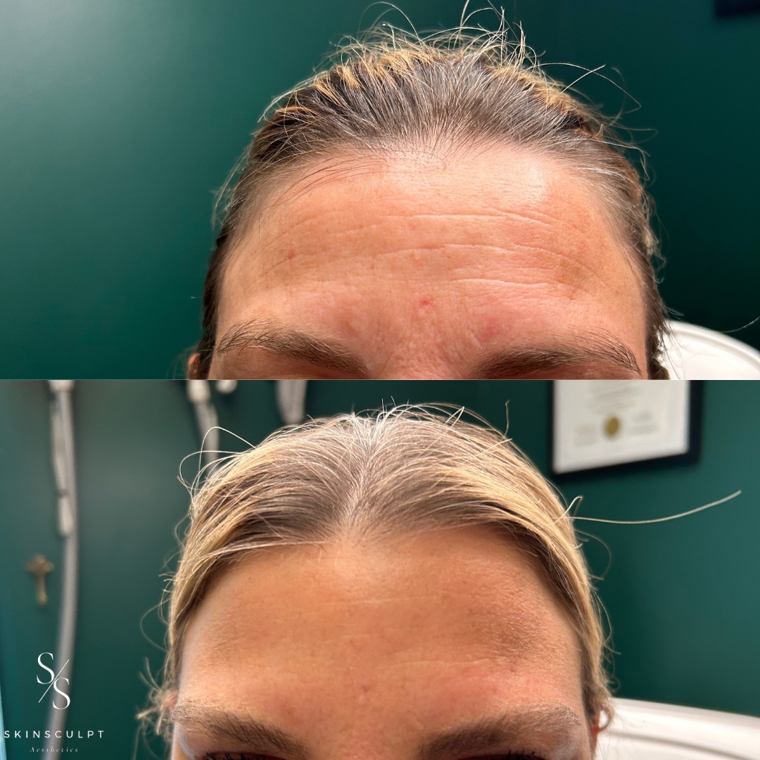 Before-After-Aesthetic-Med-Spa-Fresno-by-Skin-Sculpt-Aesthetics4