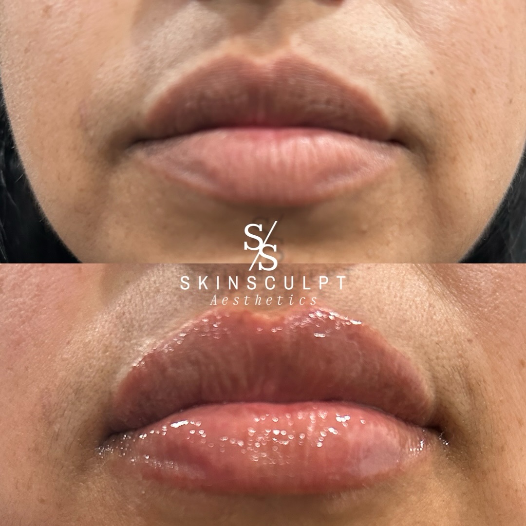Before-After-Aesthetic-Med-Spa-Fresno-by-Skin-Sculpt-Aesthetics6