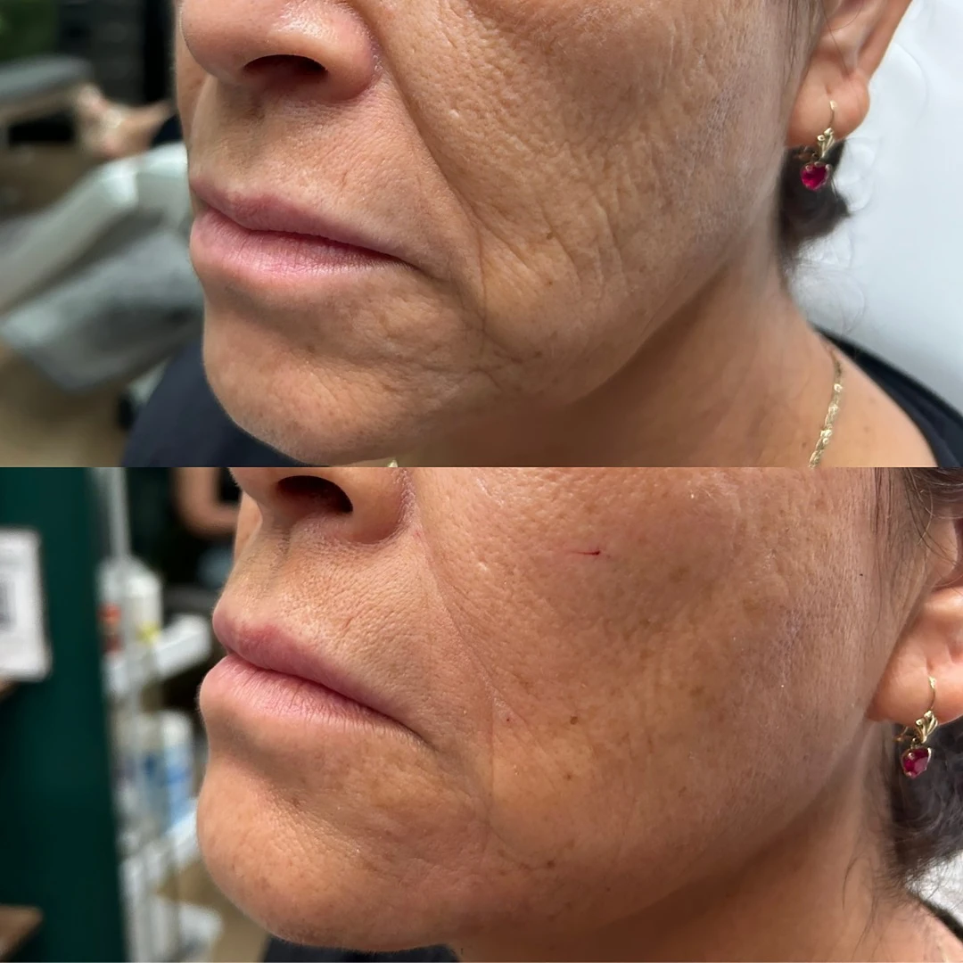Before-After-Aesthetic-Med-Spa-Fresno-by-Skin-Sculpt-Aesthetics2