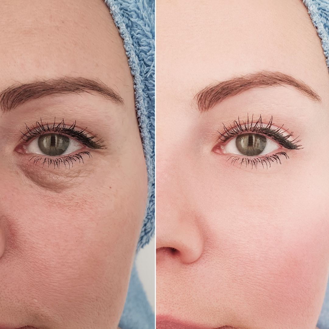 Before-After-Images-Microneedling-Skinsculpt-Aesthetics-Fresno-CA4
