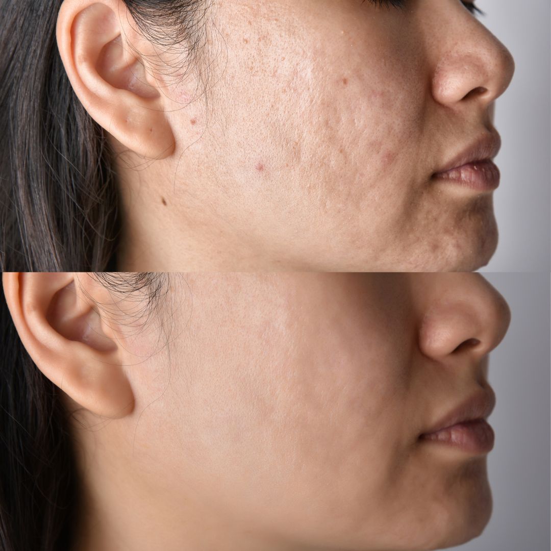 Before-After-Images-Microneedling-Skinsculpt-Aesthetics-Fresno-CA5