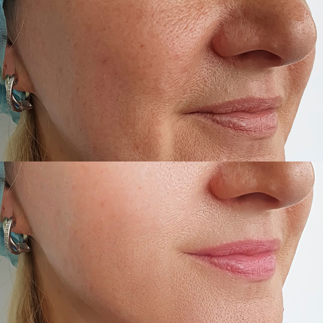 Before-After-Images-Microneedling-Skinsculpt-Aesthetics-Fresno-CA6