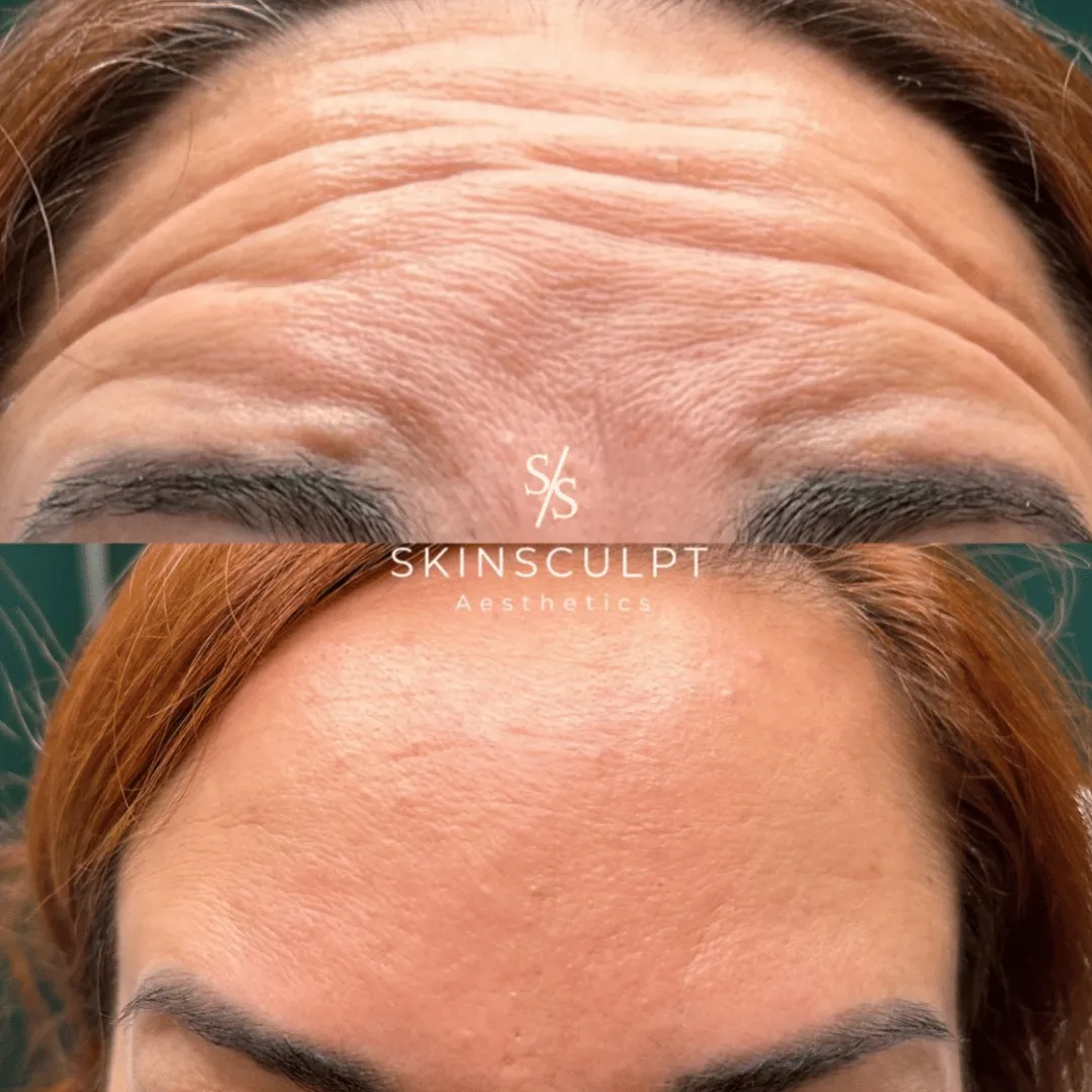 Before-After-Images-Real-Client-Transformations-Skinsculpt-Aesthetics-Fresno-CA11