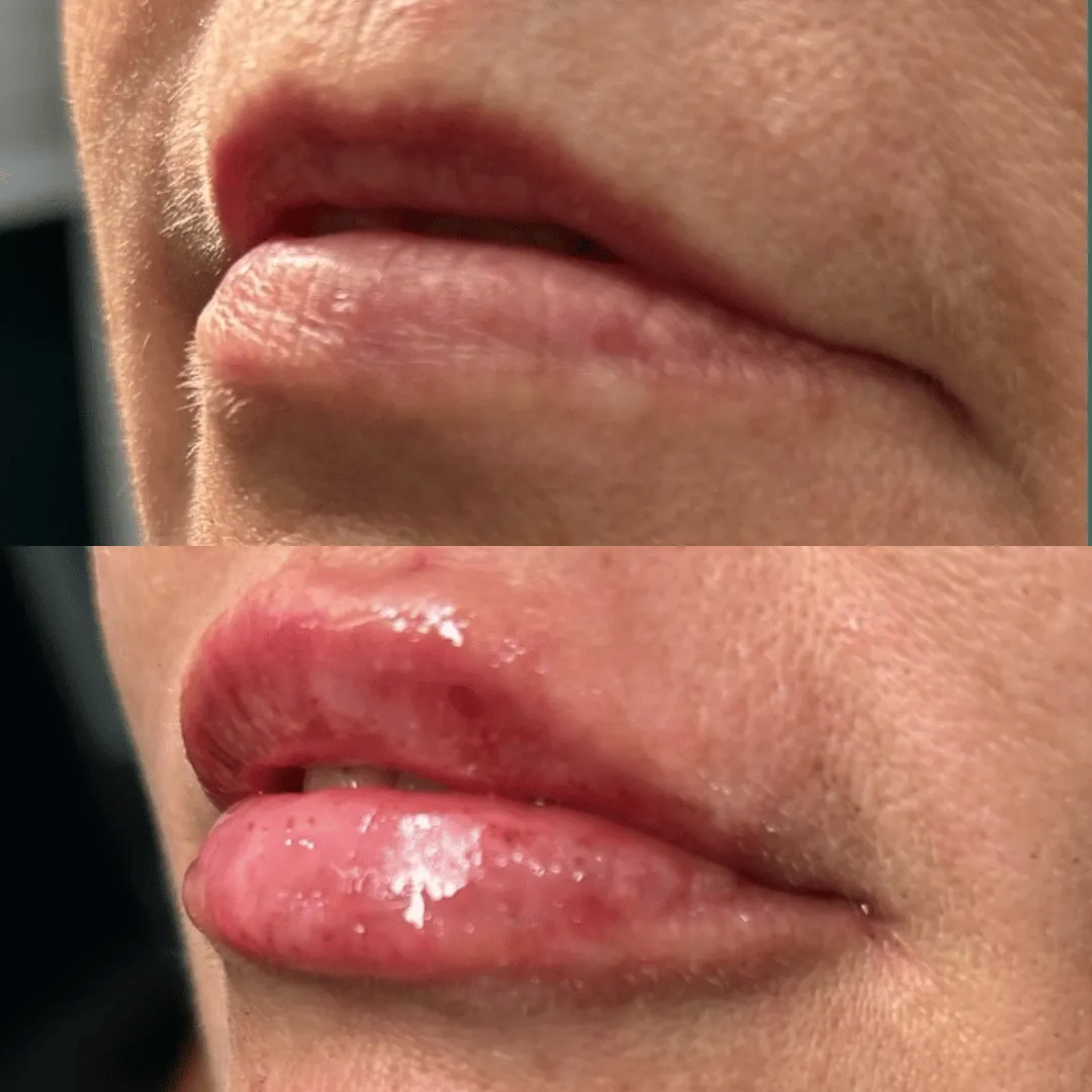 Before-After-Images-Real-Client-Transformations-Skinsculpt-Aesthetics-Fresno-CA12
