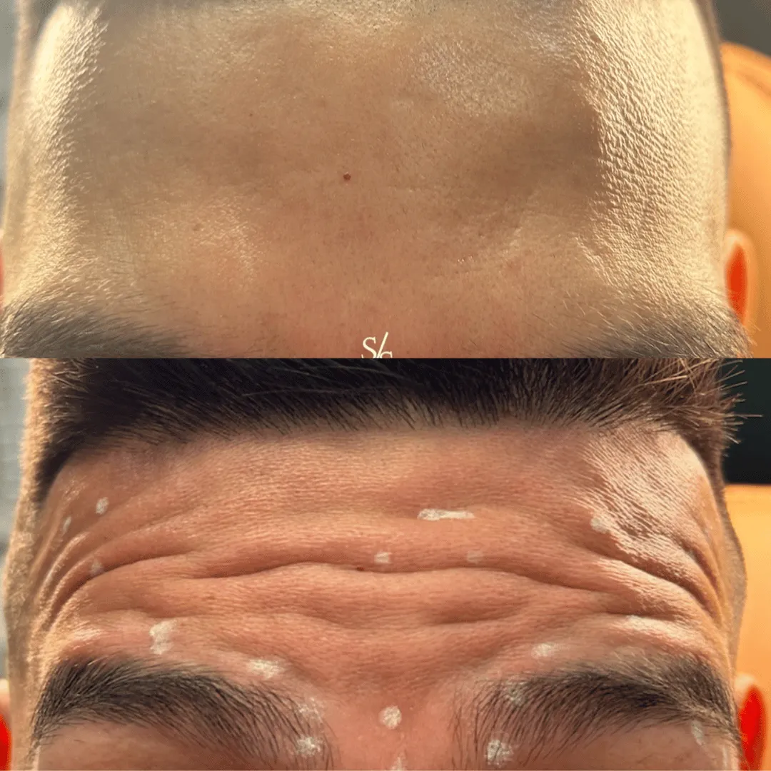 Before-After-Images-Real-Client-Transformations-Skinsculpt-Aesthetics-Fresno-CA13