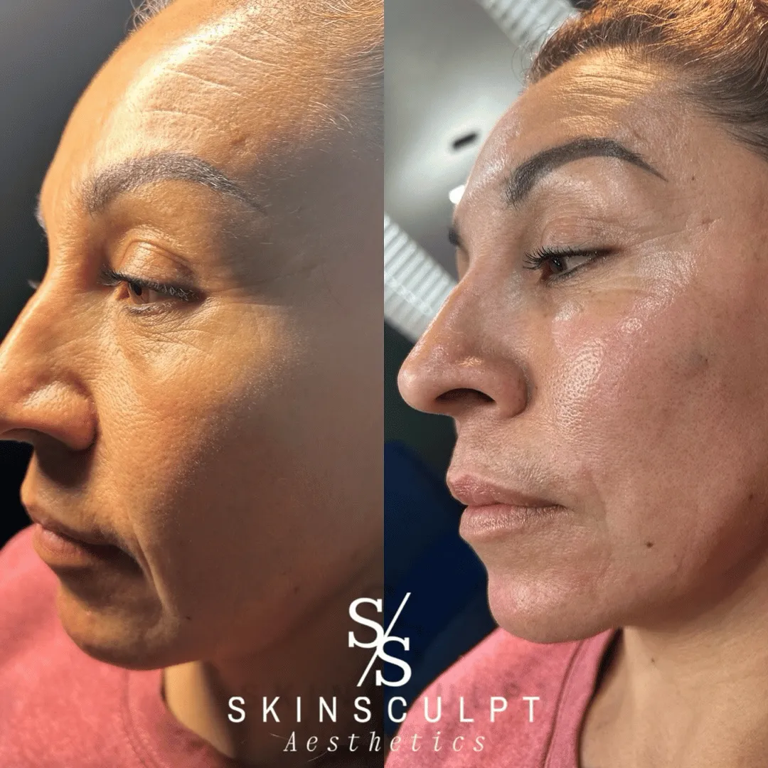 Before-After-Images-Real-Client-Transformations-Skinsculpt-Aesthetics-Fresno-CA16