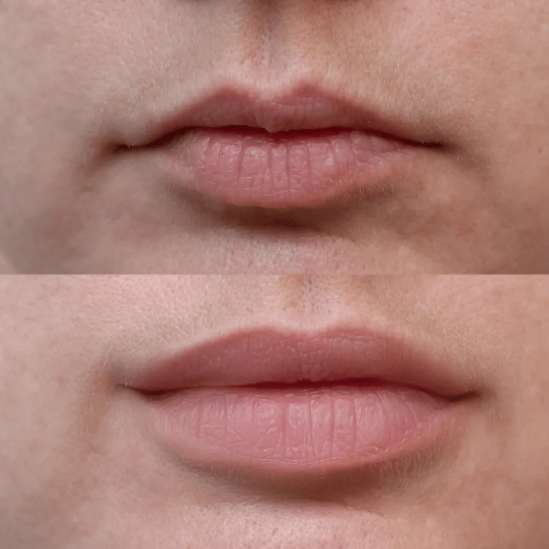 Before-After-Images-Real-Client-Transformations-Skinsculpt-Aesthetics-Fresno-CA17