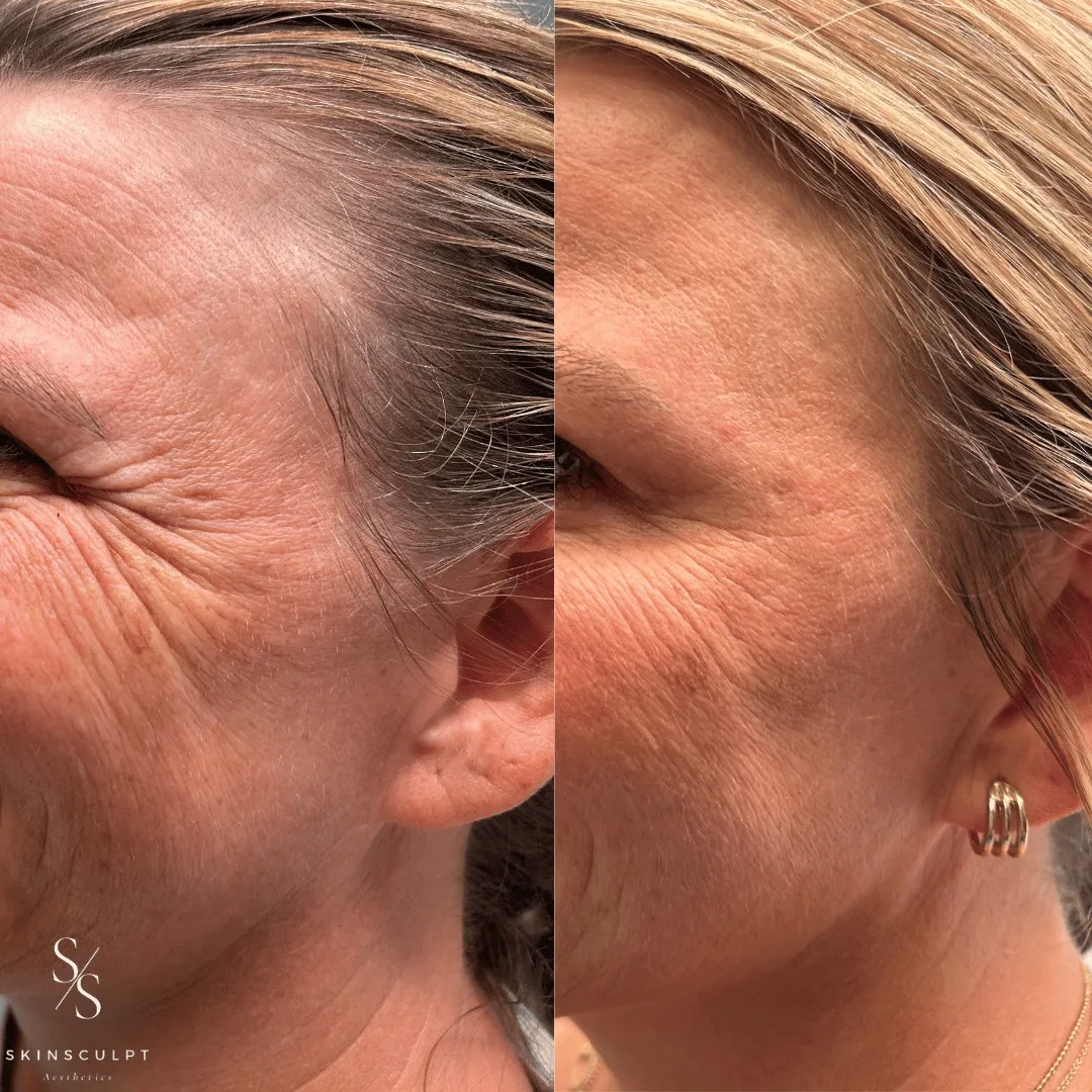 Before-After-Images-Real-Client-Transformations-Skinsculpt-Aesthetics-Fresno-CA2