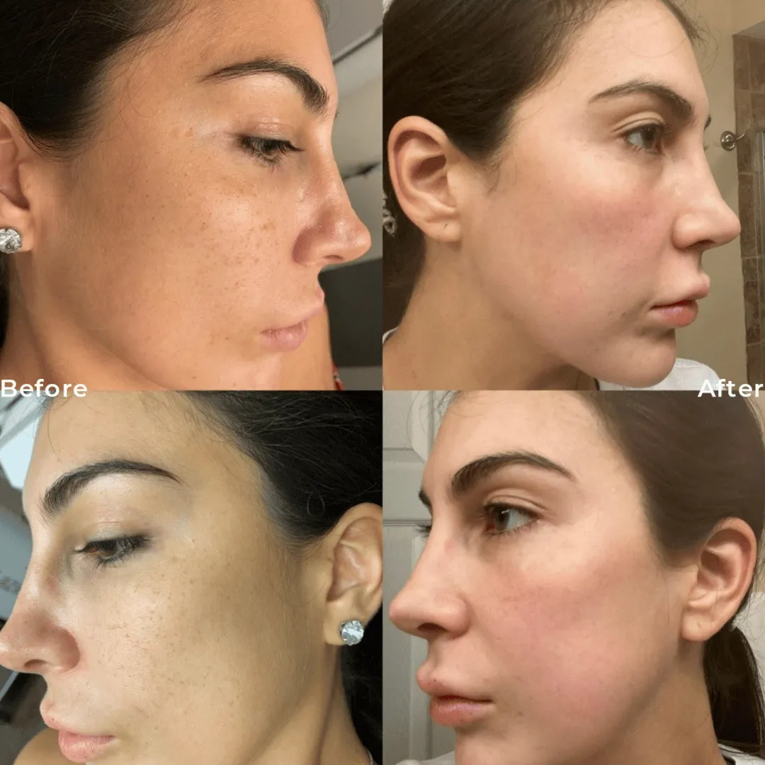 Before-After-Images-Real-Client-Transformations-Skinsculpt-Aesthetics-Fresno-CA20