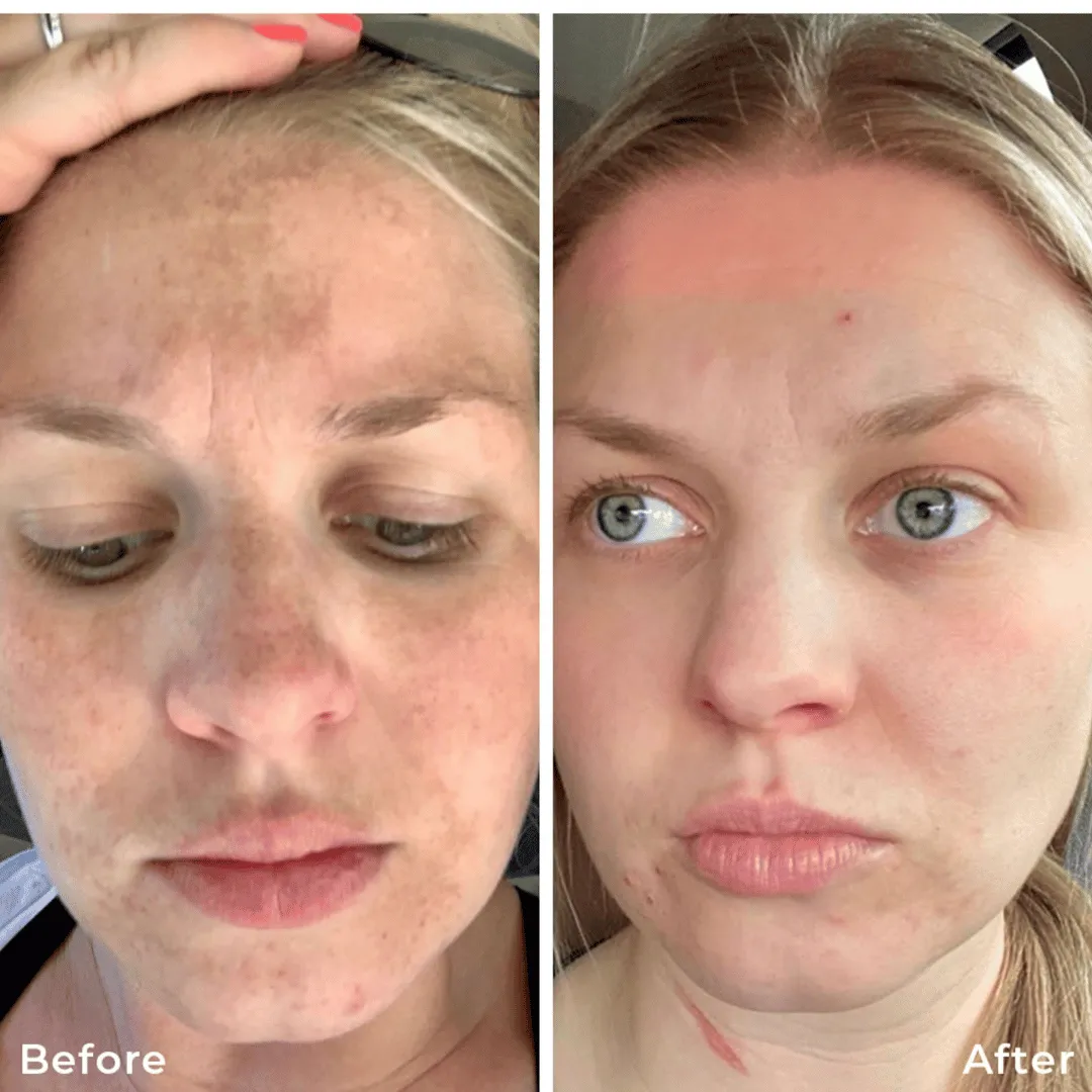 Before-After-Images-Real-Client-Transformations-Skinsculpt-Aesthetics-Fresno-CA21