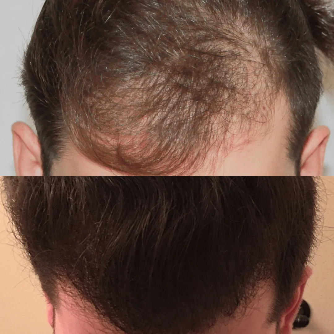 Before-After-Images-Real-Client-Transformations-Skinsculpt-Aesthetics-Fresno-CA25