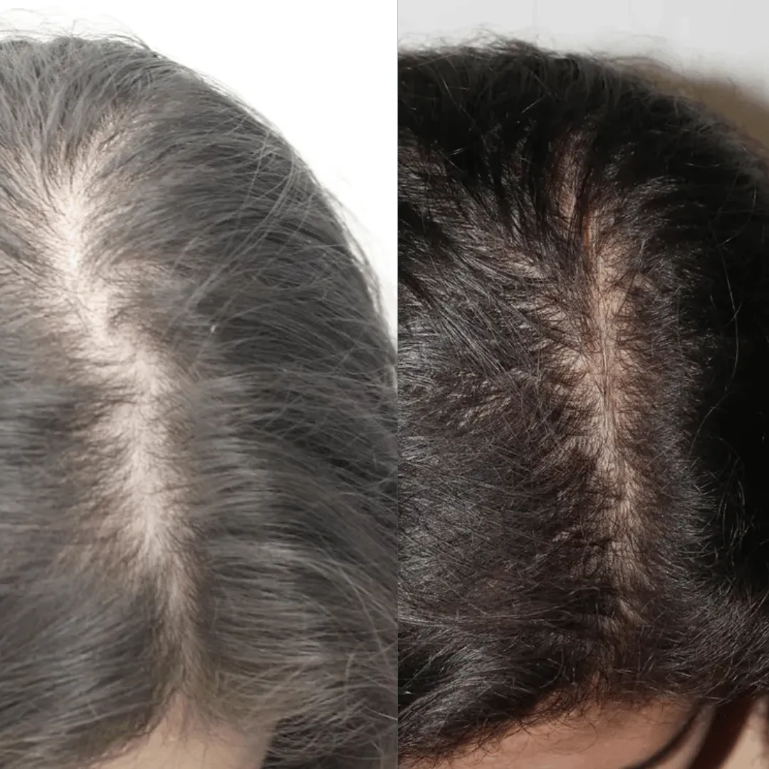 Before-After-Images-Real-Client-Transformations-Skinsculpt-Aesthetics-Fresno-CA27