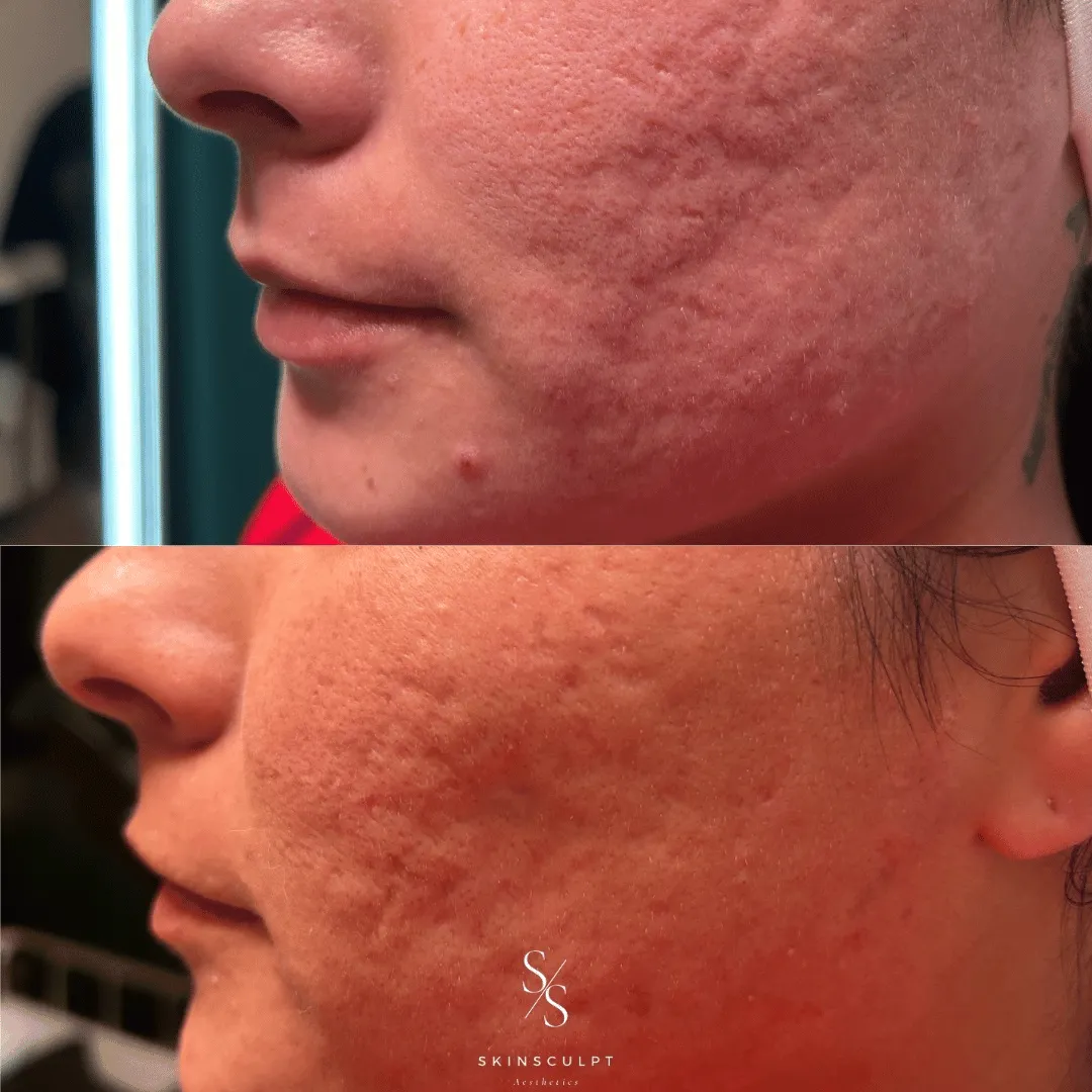 Before-After-Images-Real-Client-Transformations-Skinsculpt-Aesthetics-Fresno-CA3