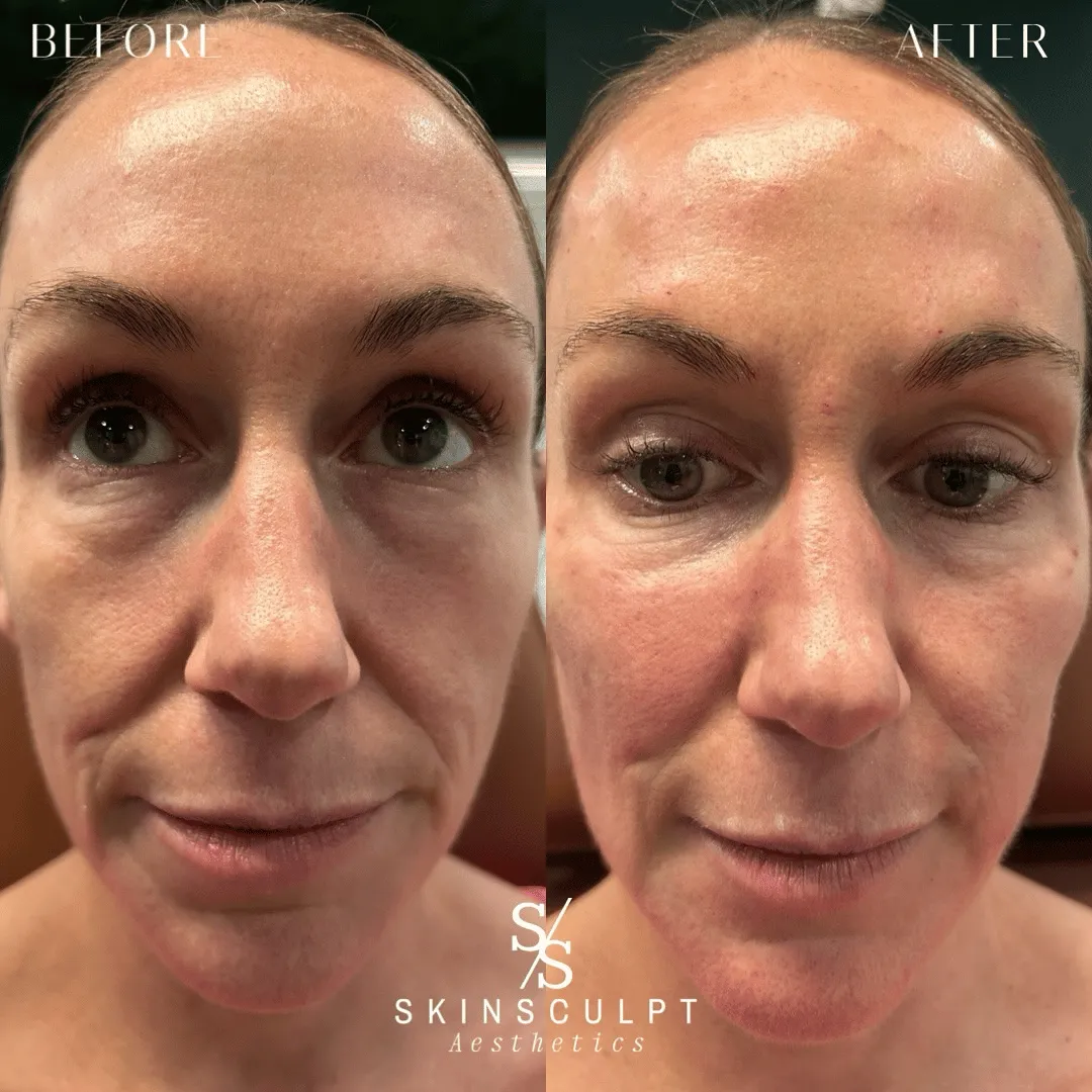 Before-After-Images-Real-Client-Transformations-Skinsculpt-Aesthetics-Fresno-CA7