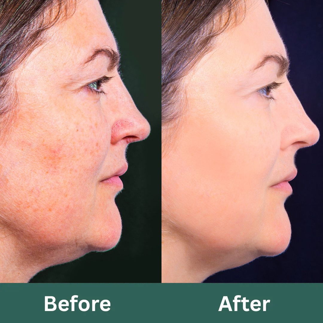 Before-After-Images-Laser-Skinsculpt-Aesthetics-Fresno-CA1_RET (1)