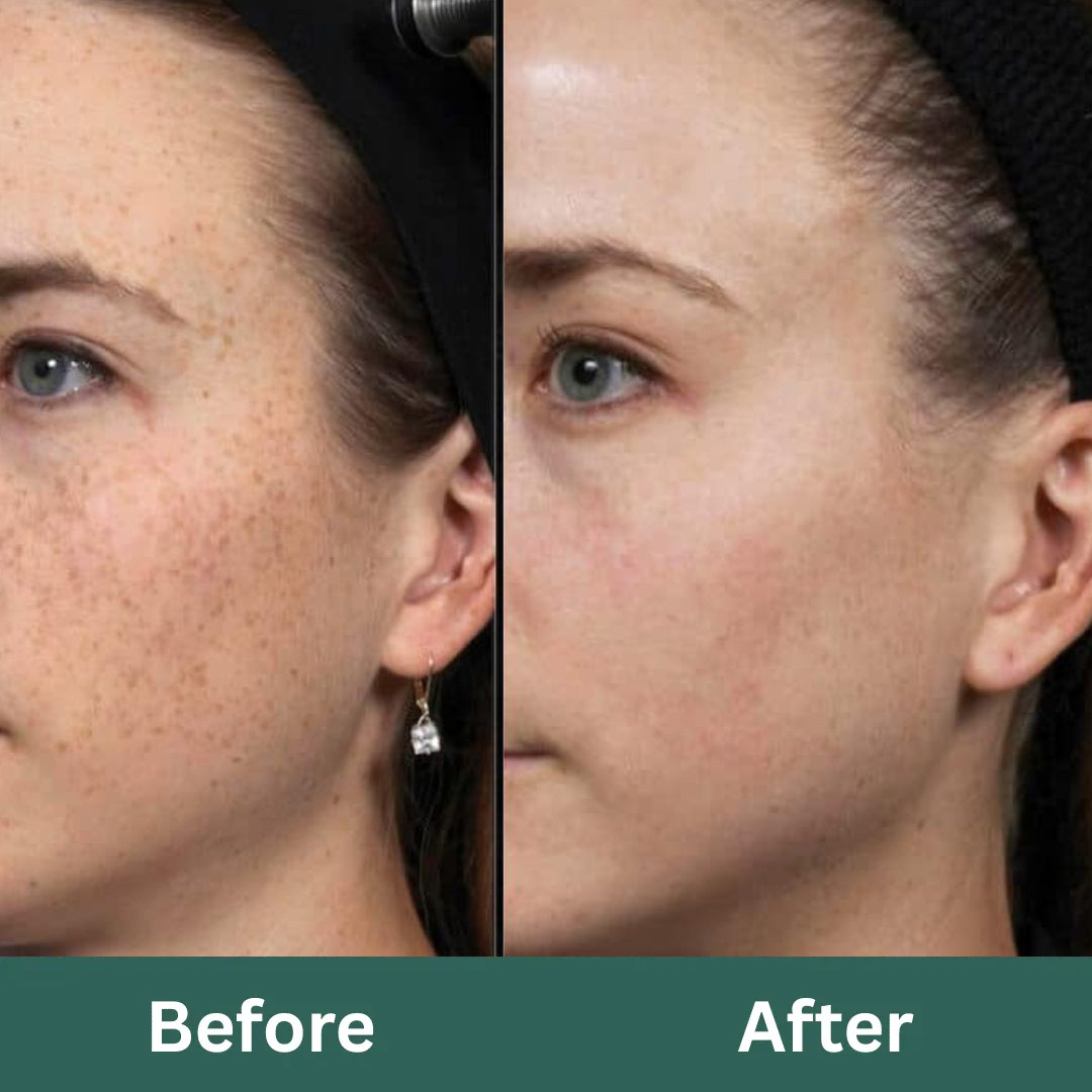 Before-After-Images-Laser-Skinsculpt-Aesthetics-Fresno-CA_RET (1)