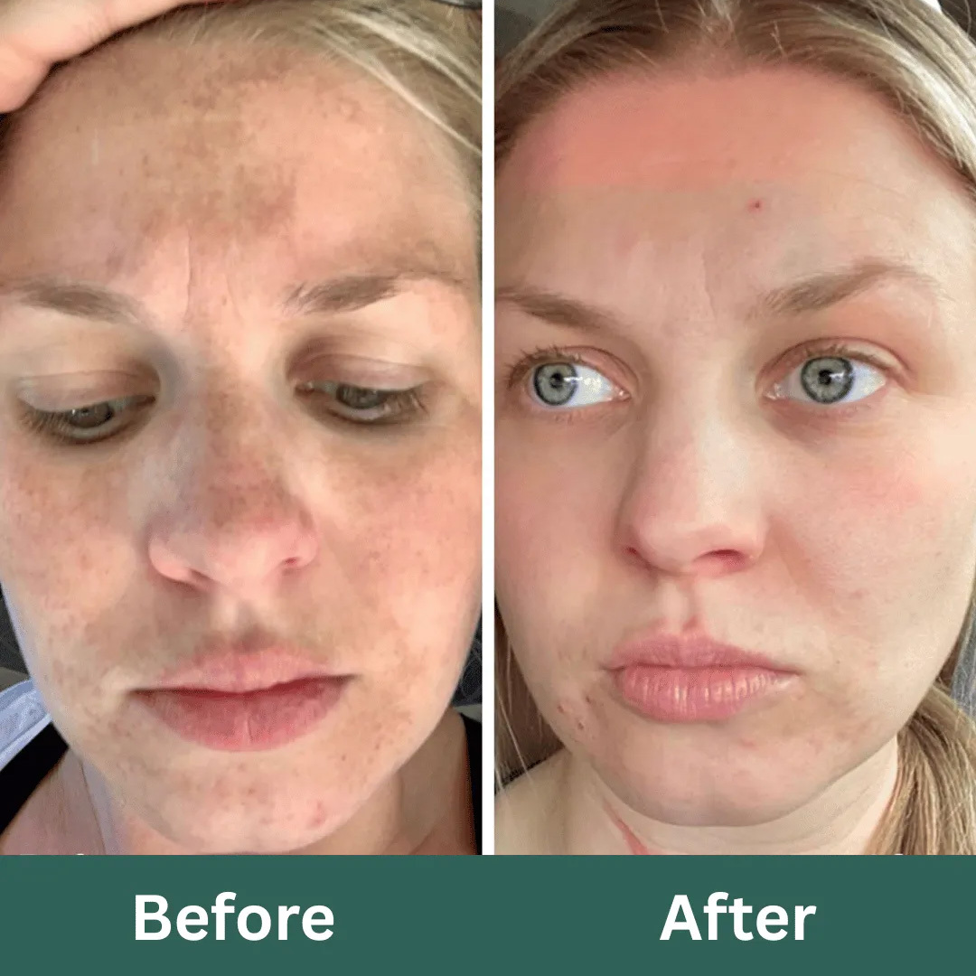 Before-After-Images-Real-Client-Transformations-Skinsculpt-Aesthetics-Fresno-CA21_RET (1)